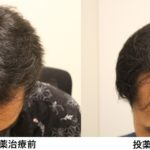［AGA治療］若ハゲがクリニックで投薬治療を開始してからの頭髪の経過Part1