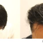 ［AGA治療］若ハゲがクリニックで投薬治療を開始してからの頭髪の経過Part2